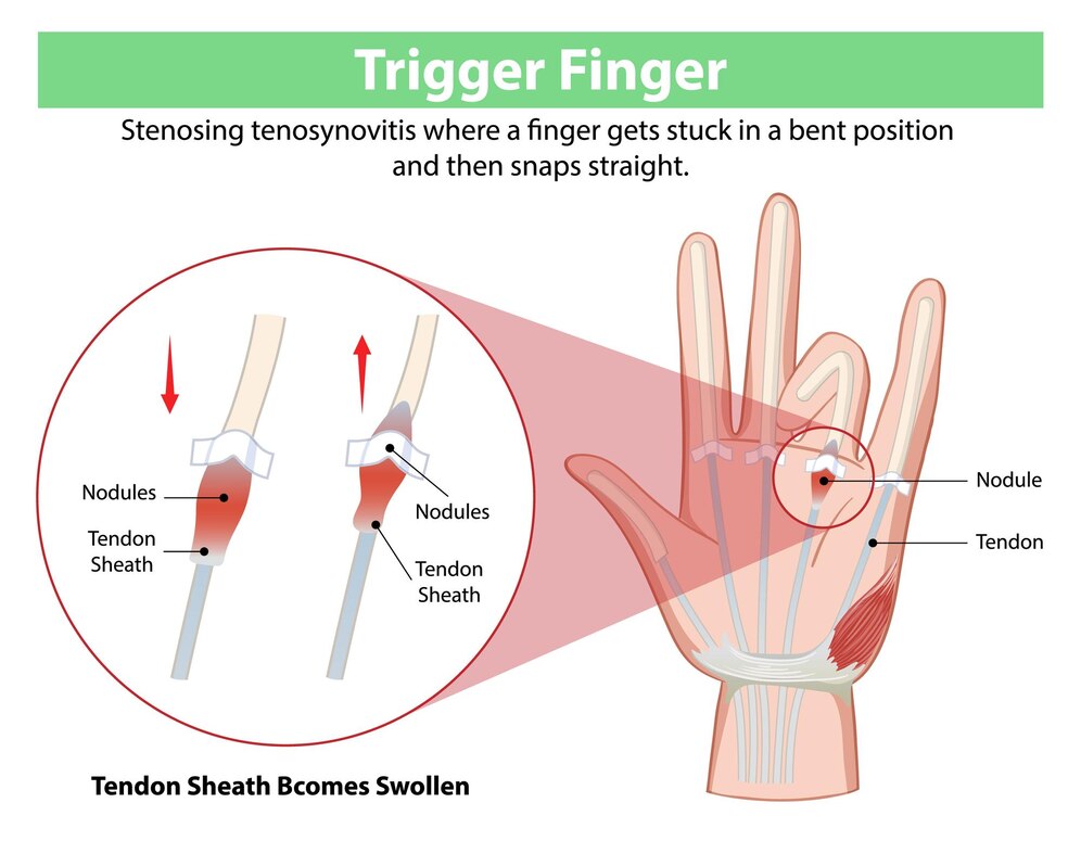 นิ้วล็อค เกิดจากอะไร